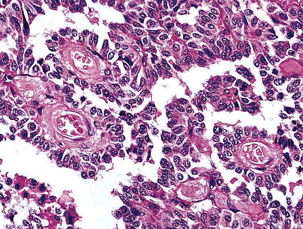 Pathology Outlines Medullary carcinoma